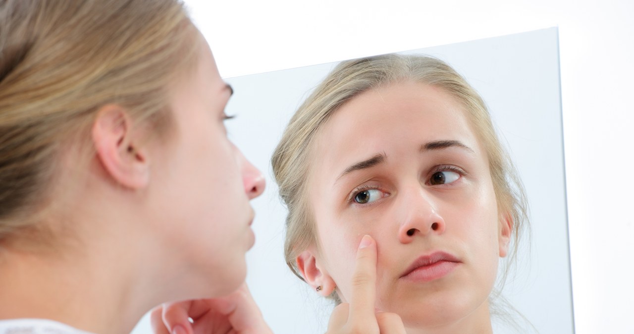 Zapomnij o zaskórnikach i wągrach. Usuniesz je domową maseczką z 2 składników