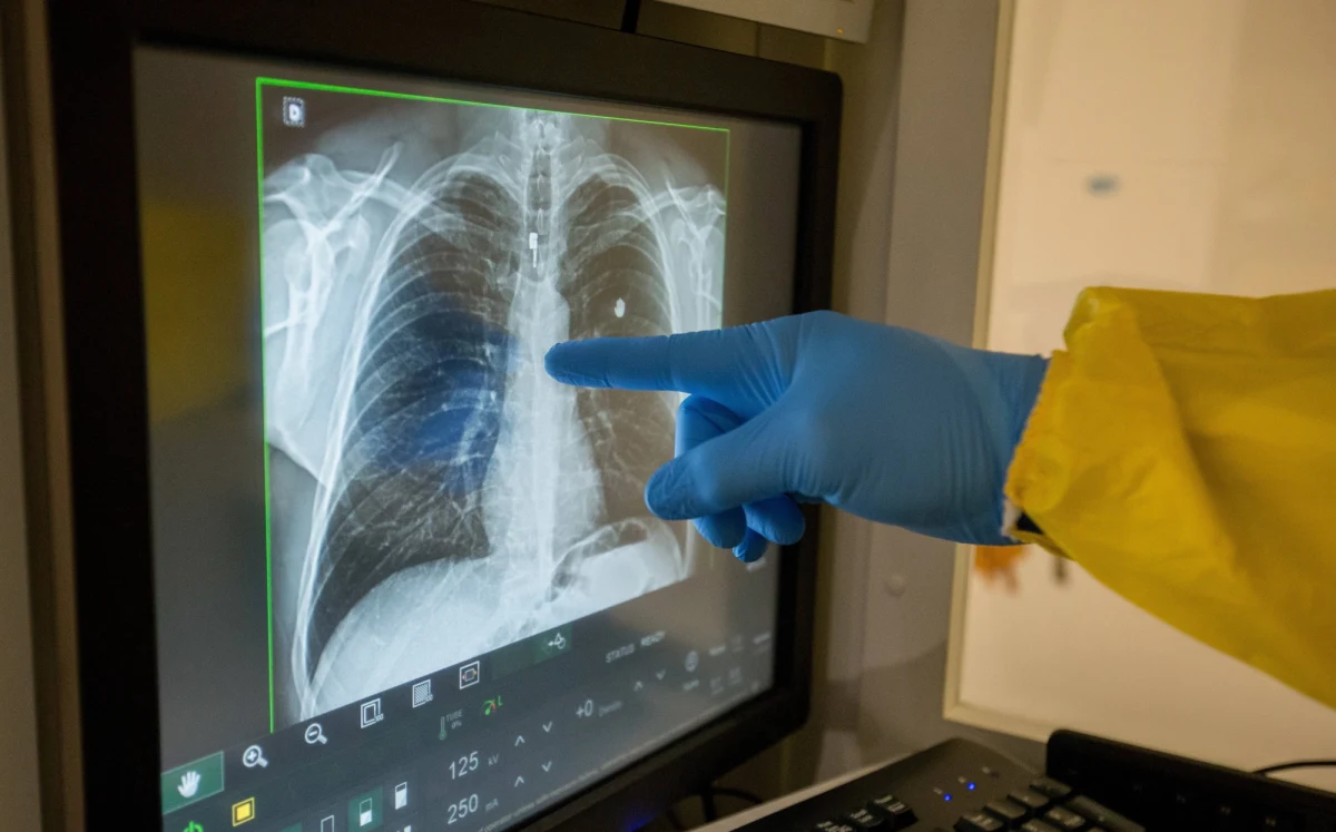 U ponad 56 proc. pacjentów, u których wystąpił COVID-19, następuje poprawa w funkcjonowaniu płuc po 12 tygodniach od hospitalizacji - wynika ze studium przedstawionego przez Europejskie Towarzystwo Oddechowe, na które powołuje się w poniedziałek hiszpański dziennik "La Verdad".