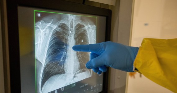 U ponad 56 proc. pacjentów, u których wystąpił COVID-19, następuje poprawa w funkcjonowaniu płuc po 12 tygodniach od hospitalizacji - wynika ze studium przedstawionego przez Europejskie Towarzystwo Oddechowe, na które powołuje się w poniedziałek hiszpański dziennik "La Verdad".