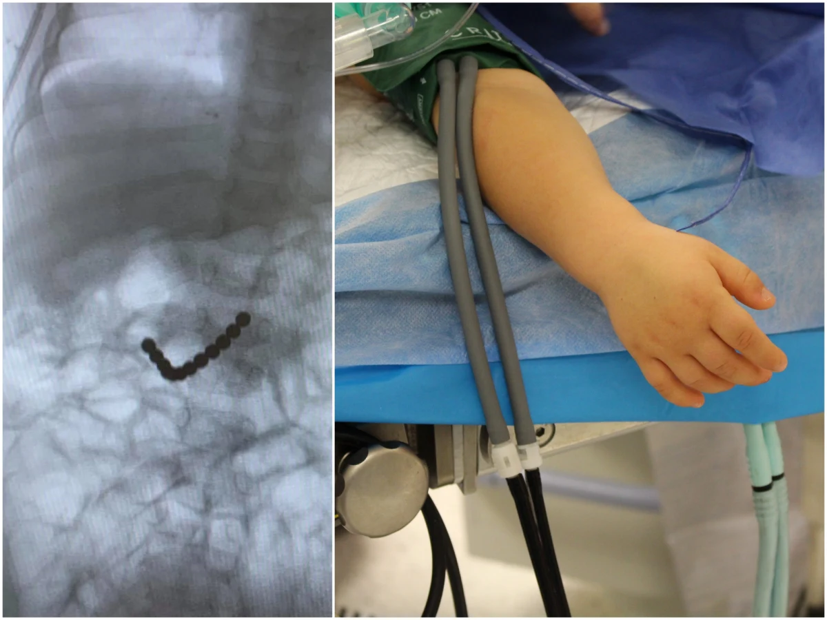 Aż 50 magnesów neodymowych wyciągnęli z brzucha dziecka krakowscy lekarze. "Magnesy te stanowią poważne zagrożenie w organizmie dziecka" - ostrzega Wojciech Górecki kierownik chirurgii dziecięcej Uniwersyteckiego Szpitala Dziecięcego w Krakowie. I apeluje: z rozwagą kupujmy zabawki!