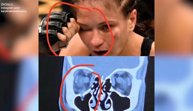 MMA. Karolina Kowalkiewicz wróciła do intensywnych treningów po ciężkiej kontuzji oka. wideo