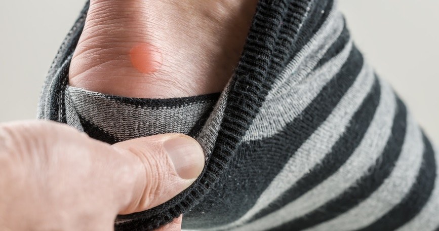 Modzele Modzele i odciski: Przyczyny i leczenie. Jak się ich pozbyć? - Kobieta ...