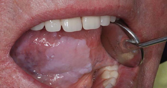 Jakie Są Objawy Raka Jamy Ustnej Porady W Interiapl