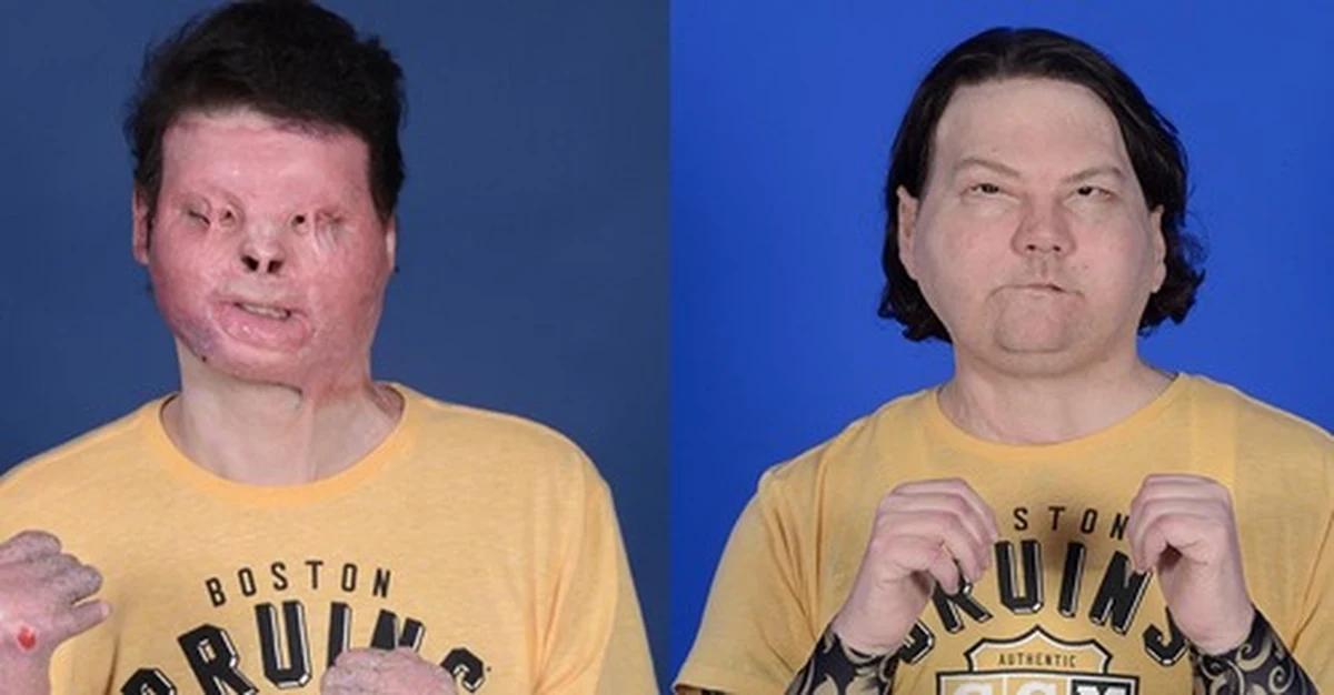 "Medycznym cudem" nazywa dziennik „USA Today” udany przeszczep twarzy i rąk mężczyźnie, który miał wypadek samochodowy. Była to pierwsza zakończona sukcesem tego rodzaju operacja na świecie.