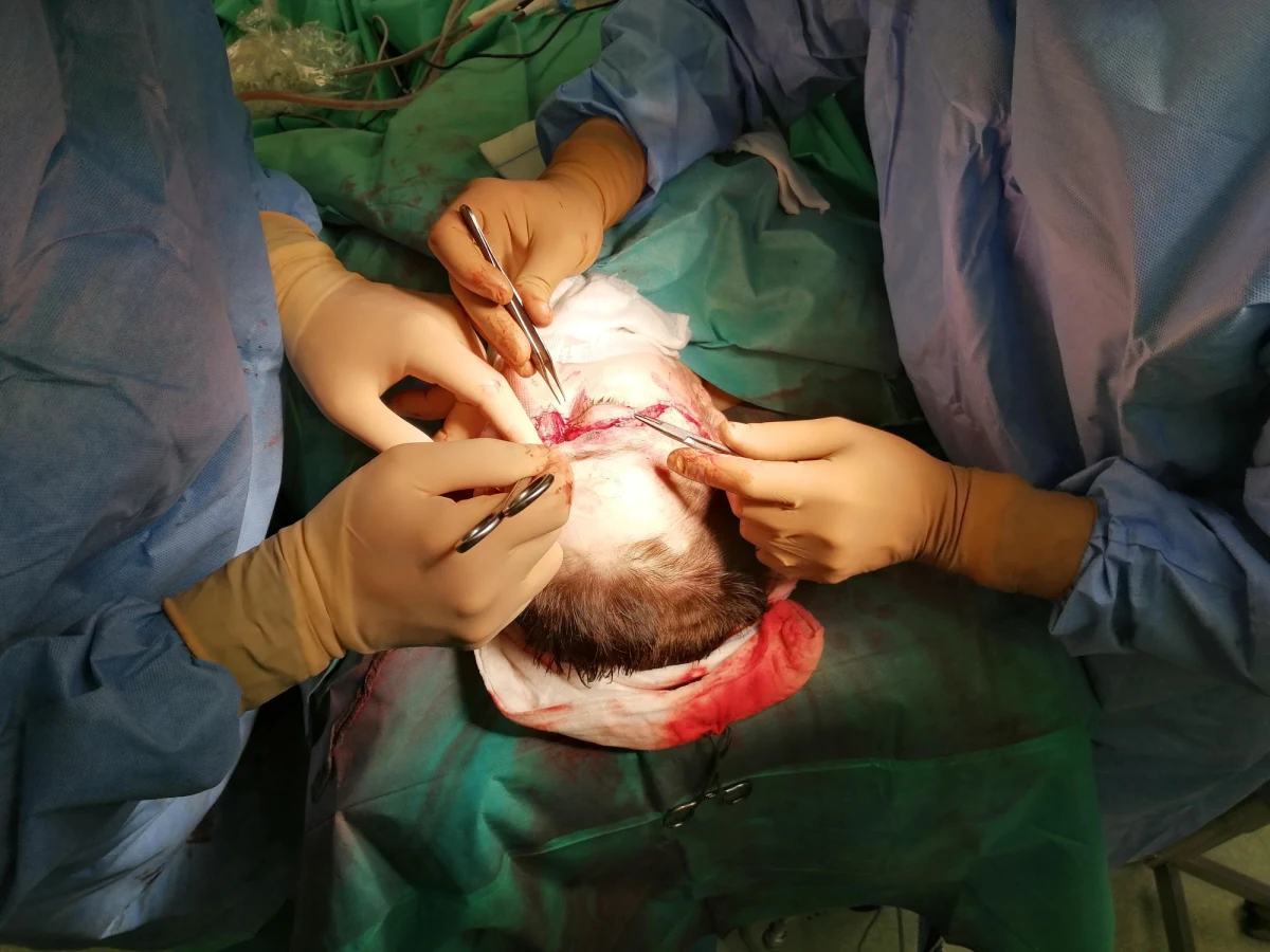 Kolejny sukces chirurgów z Narodowego Instytutu Onkologii w Gliwicach. Zespół pod kierunkiem prof. Adama Maciejewskiego przeprowadził bardzo rozległy zabieg replantacji skalpu u 39-letniej pacjentki. Kobieta miała wypadek w pracy. Doznała oskalpowania głowy i karku. 