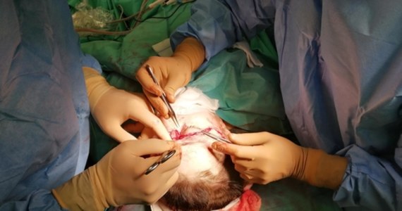 Kolejny sukces chirurgów z Narodowego Instytutu Onkologii w Gliwicach. Zespół pod kierunkiem prof. Adama Maciejewskiego przeprowadził bardzo rozległy zabieg replantacji skalpu u 39-letniej pacjentki. Kobieta miała wypadek w pracy. Doznała oskalpowania głowy i karku. 