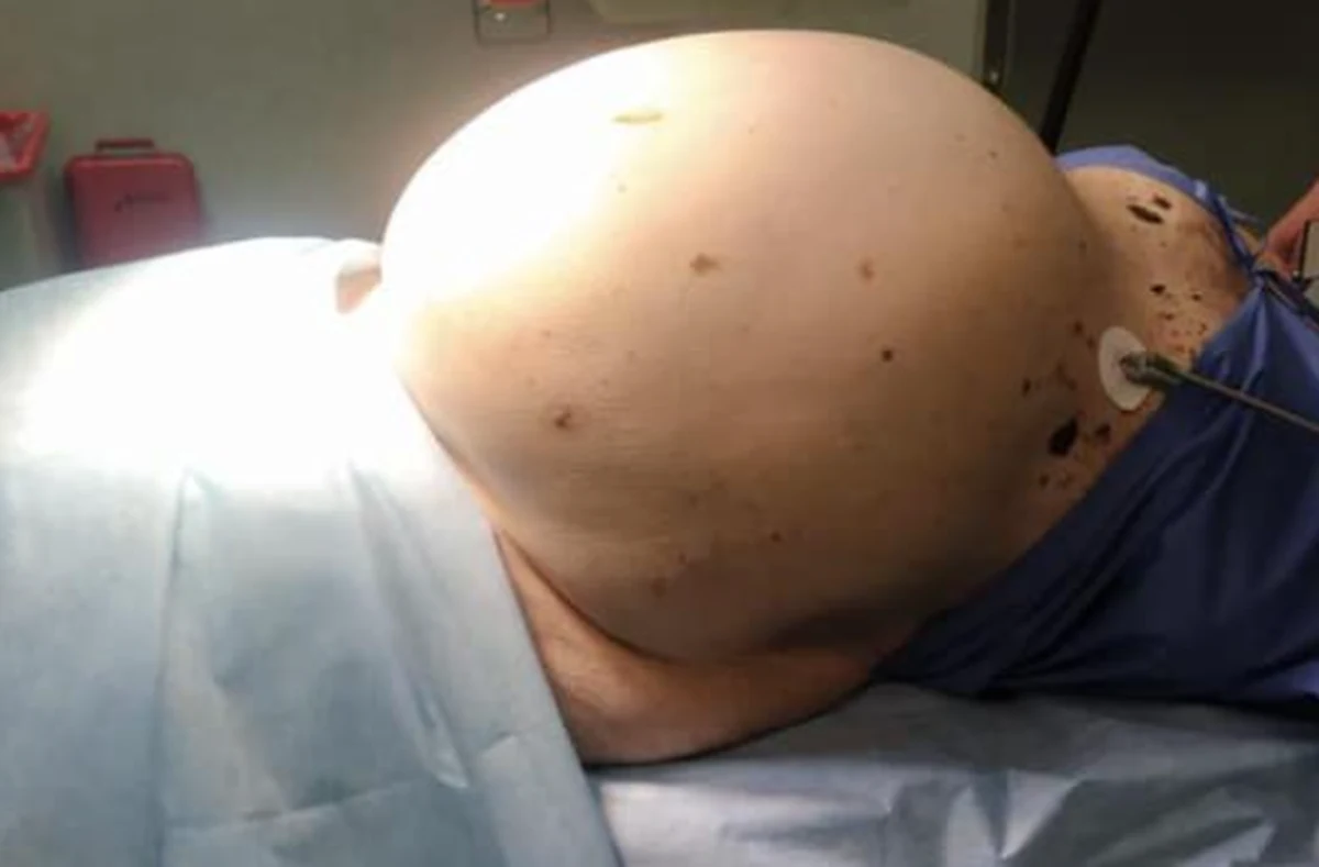 74-letnia kobieta w ostatniej chwili poprosiła o pomoc chirurgów z Namysłowa w woj. opolskim. Wcześniej – jak przyznała – leczyła się tylko za pomocą teleporad. W tym czasie jej brzuch robił się coraz większy. Okazało się, że w jamie brzusznej urósł jej olbrzymi guz.