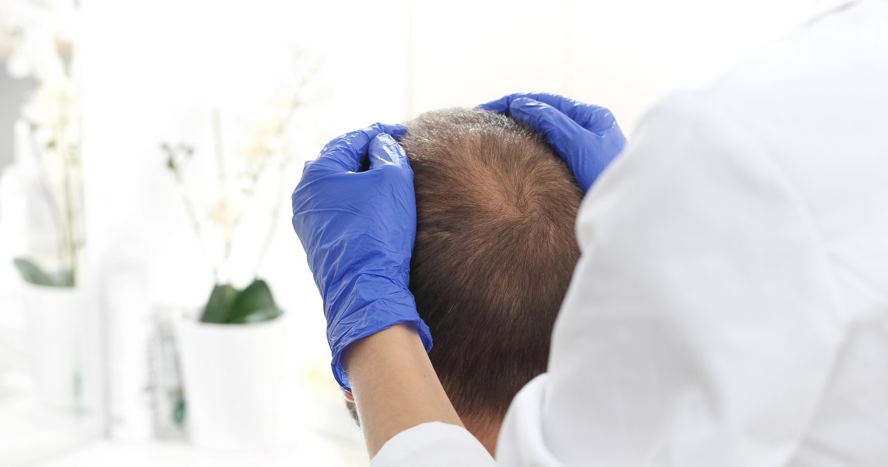 Tradycyjna medycyna chińska w walce z łysieniem androgenowym