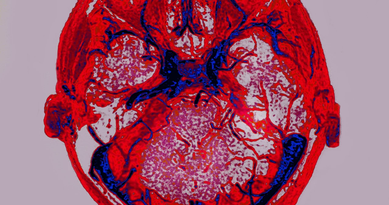 Badanie pokazało, jak SARS-CoV-2 może atakować mózg