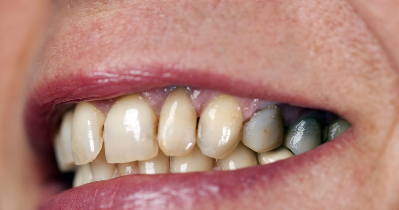 Dbaj o zęby, żyj dłużej. Sprawdź, co wykazały najnowsze badania