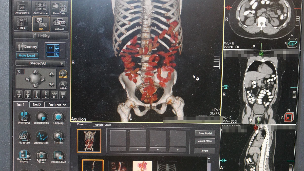 Funkcjonariusze Krajowej Administracji Skarbowej zatrzymali na lotnisku im. Chopina w Warszawie 44-latka, który przemycał ponad 1,5 kg heroiny. Narkotyk miał w żołądku w 98 kapsułkach. 