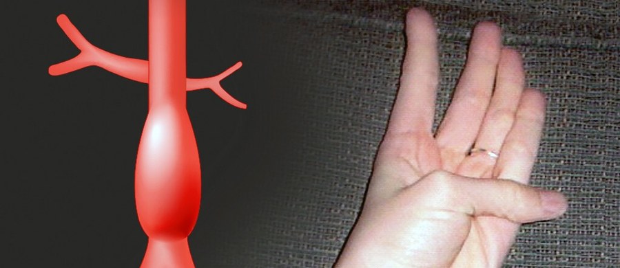 Prosty „test kciuka dłoni” wskaże, czy grozi nam tętniak aorty. Zdaniem amerykańskich kardiologów, test należy uwzględnić w standardowych badaniach fizykalnych, szczególnie w przypadku osób, u których w rodzinie wystąpiło już to schorzenie. 