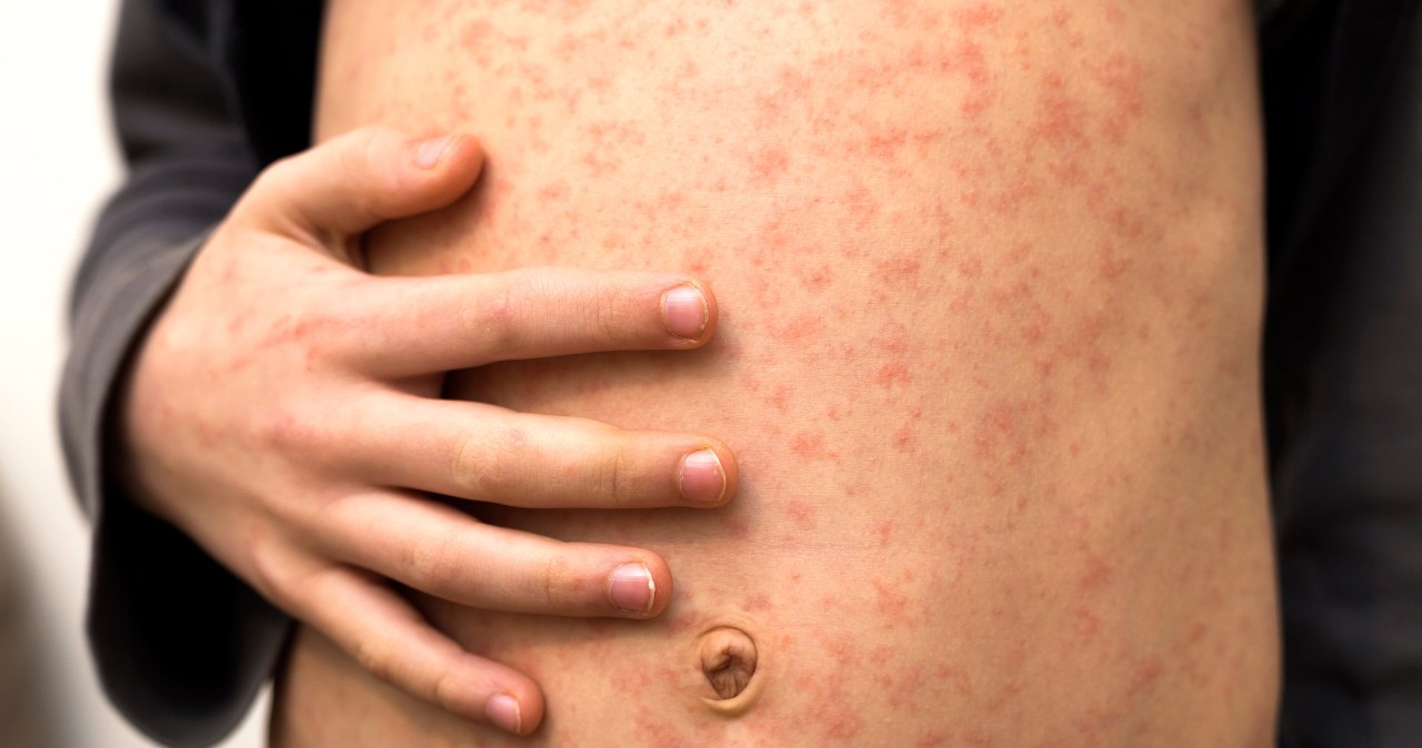 Groźna choroba wróciła. Może dosłownie "wymazać" odporność