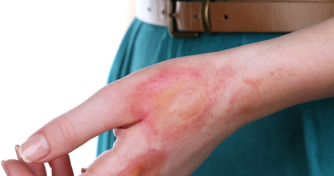 Ewolucyjna rola ognia. Oparzenia mogły ukształtować naszą odporność