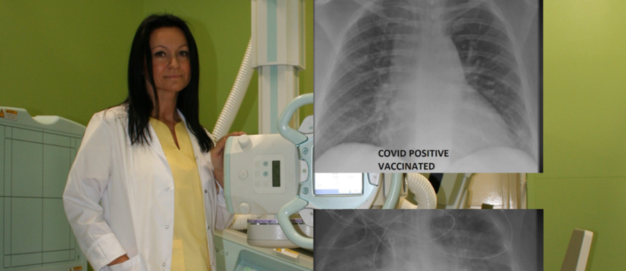 W szpitalu w Saint Louis prześwietlono płuca chorującym na Covid-19. Jeden z nich był zaszczepiony przeciwko koronawirusowi, a drugi nie. O porównanie zdjęć RTG amerykańskich pacjentów poprosiliśmy radiolog Aldonę Jarosz ze Szpitala św. Ludwika w Krakowie. 