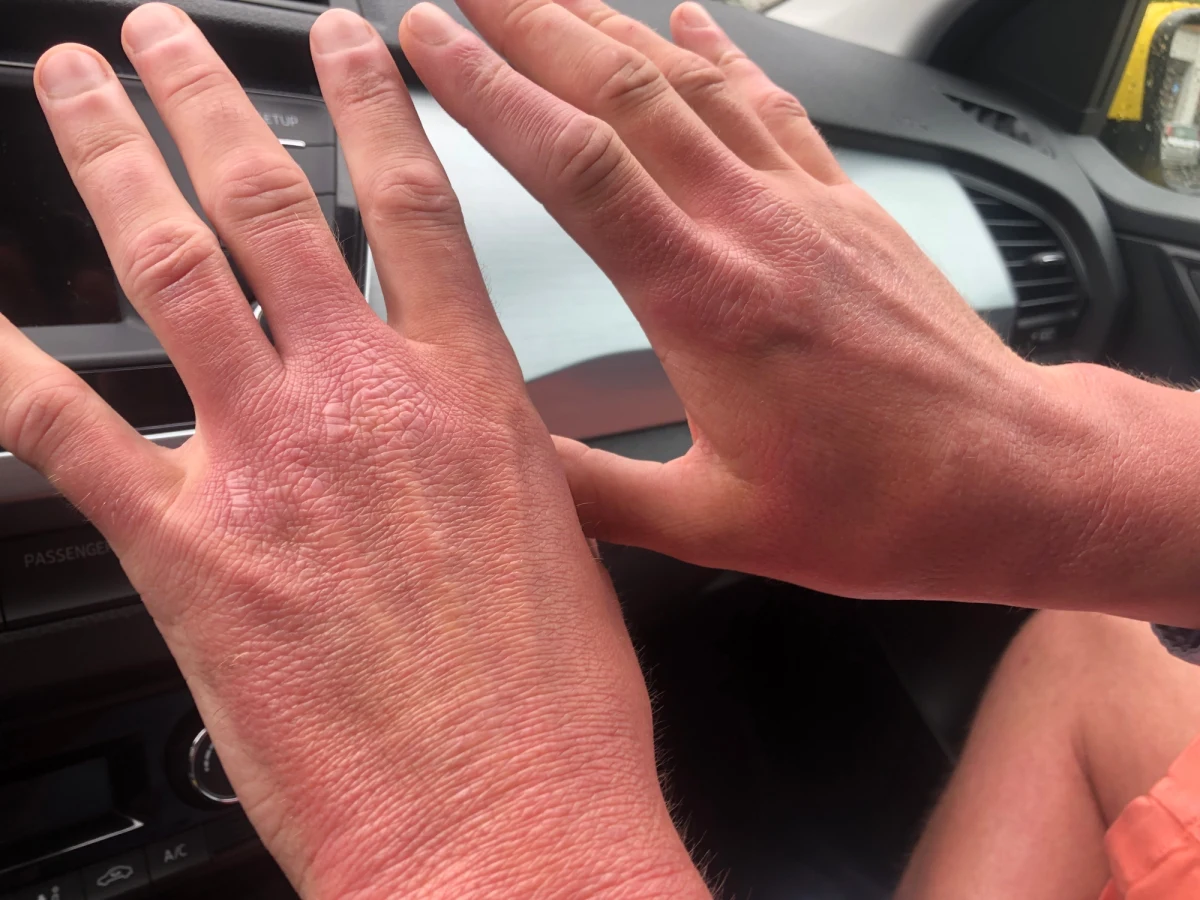 "Ten lek jest jedyną szansą na normalne życie" - tak w liście do premiera Mateusza Morawieckiego piszą pacjenci z ciężką postacią Atopowego Zapalenia Skóry. W ten sposób starają się o dostęp do nowoczesnej terapii biologicznej.