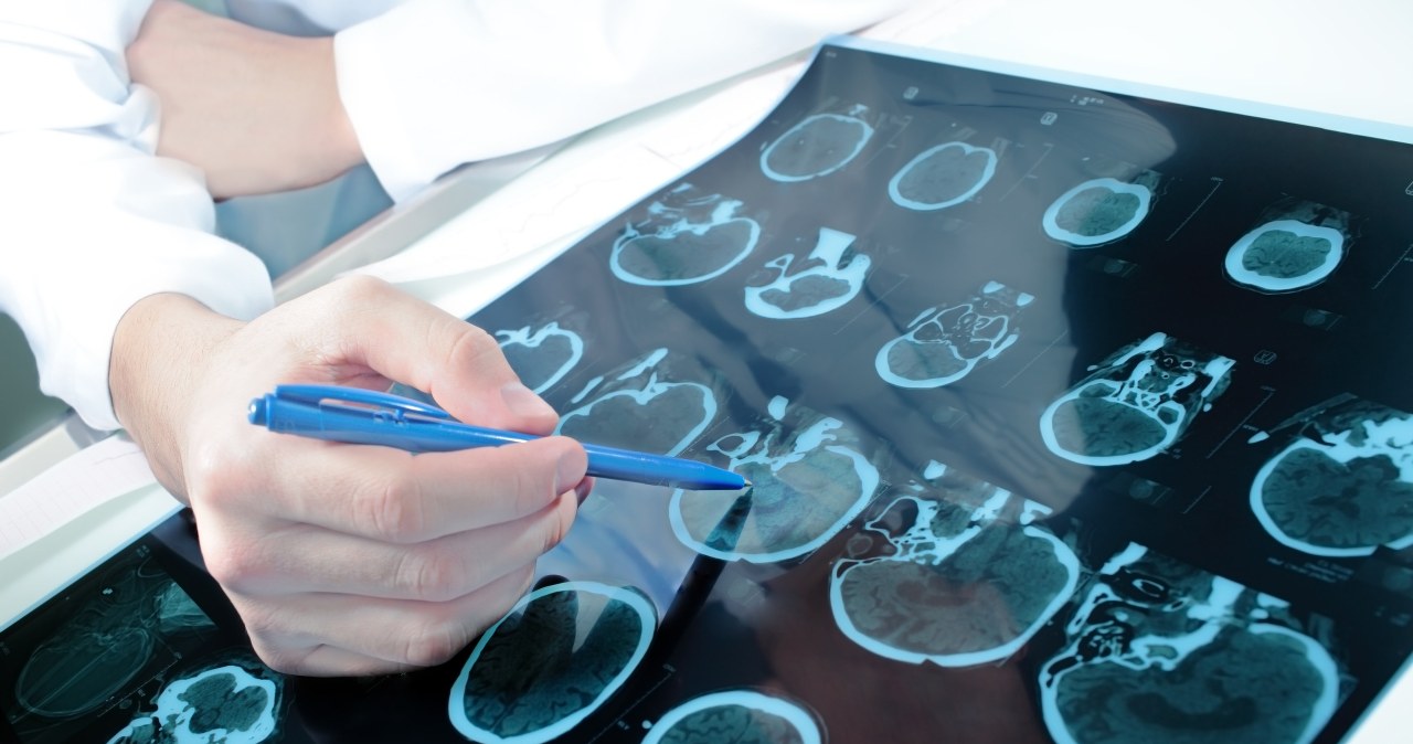 Polacy opracowali nowy sposób podawania leków. Mogą zmienić terapię raka mózgu