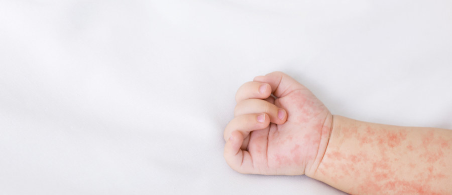 Mamy największy od dwóch dekad wzrost niezaszczepionych dzieci przeciwko odrze. Tak wynika z najnowszego raportu Światowej Organizacji Zdrowia. Jak tłumaczą specjaliści, to efekt zaniku odporności zbiorowej na tę chorobę. „Proszę sobie uzmysłowić, że odra jest wielokrotnie bardziej zaraźliwa niż Covid-19. Jedna chora osoba może zainfekować nawet 18 innych. To trzykrotnie więcej niż w przypadku grypy czy SARS-CoV-2” – wylicza prof. Hanna Czajka kierująca poradnią chorób zakaźnych w Szpitalu Dziecięcym im. św. Ludwika w Krakowie. 