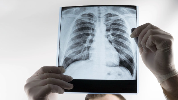 Więcej pacjentów z zaawansowanym nowotworem płuc. "To efekt pandemii"