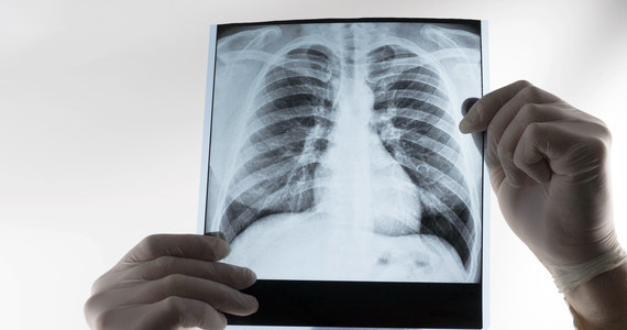 Niepokojąco rośnie liczba pacjentów z zaawansowanym rakiem płuca. Według danych Polskiego Towarzystwa Onkologicznego, takich przypadków jest o ponad 10 procent więcej niż przed pandemią. W Faktach RMF FM sprawdzamy, jak czwarta fala wpływa na leczenie chorób innych niż zakażenie koronawirusem.