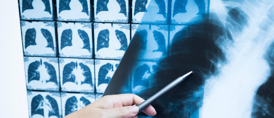 W Uniwersyteckim Szpitalu Klinicznym przy ul. Borowskiej we Wrocławiu można bezpłatnie zbadać płuca niskodawkową tomografią komputerową. Używa się tam do tego tomografu stosowanego u dzieci. 