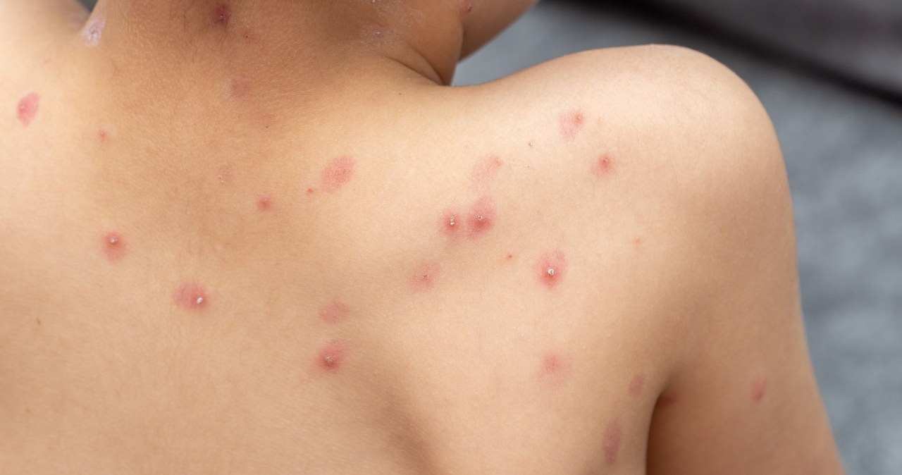 To wina Brytyjczyków. Poznaliśmy przyczynę niszczycielskiej epidemii z 1789