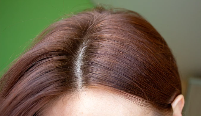 Co trzecia osoba, która przeszła COVID-19, może cierpieć na nadmierne wypadanie włosów