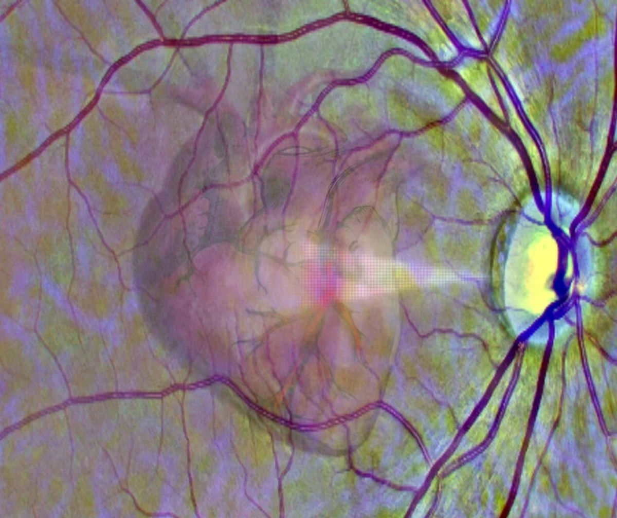 Mówimy często, że oczy są zwierciadłem duszy. Międzynarodowy zespół naukowców pod kierunkiem badaczy z University of Leeds twierdzą, że oczy mogą być też zwierciadłem serca. Na łamach czasopisma "Nature Machine Intelligence" informuje, że opracowany przez nich algorytm sztucznej inteligencji jest w stanie na podstawie obrazu siatkówki oka z 70-80 procentową dokładnością przewidzieć wysokie ryzyko ataku serca w następnym roku. W ten sposób, przy okazji wizyty u okulisty można dostać sugestię, by jak najszybciej wybrać się do kardiologa. 