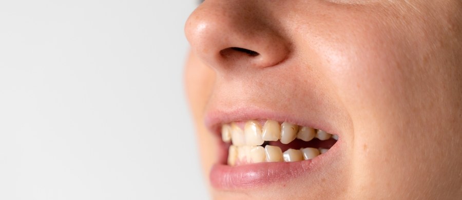 Klasyczny, metalowy aparat ortodontyczny już dawno nie jest powodem do wstydu, a staje się modnym atrybutem. Nawet serialowa Brzydula może teraz zostać uznana za influencerkę, wzorem coraz większej grupy internetowych osobowości z dumą prezentujących aparaty na zębach. Jednak aparat ortodontyczny to nie tylko trend czy droga do ładnego uśmiechu, ale przede wszystkim ważna procedura lecznicza. Poznaj 5 nietypowych dolegliwości wskazujących na konieczność wizyty u ortodonty.
