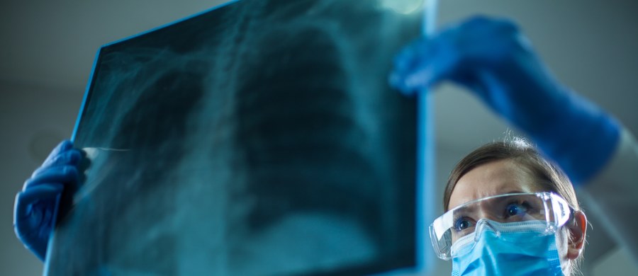 Ponad 22 proc. pacjentów, którzy leczeni byli na oddziałach intensywnej terapii z powodu ciężkiego przebiegu Covid-19, cierpi po przebyciu tej choroby na idiopatyczne włóknienie płuc, wynika z badania przeprowadzonego przez hiszpańskich naukowców.