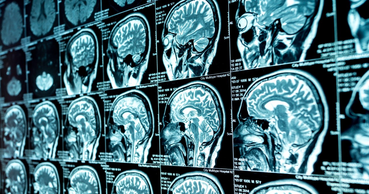 Naukowcy odkryli problem. Słynna teoria o ADHD mogła być iluzją