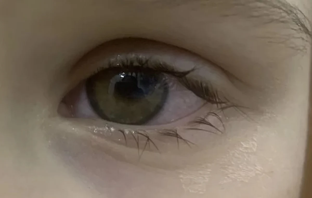 ​Coraz więcej dzieci z Ukrainy z urazami oczu trafia do polskich szpitali. W lubelskiej klinice okulistycznej przeprowadzono operację u siedmioletniej dziewczynki z Kijowa, która miała przebite oko. Do kliniki jadą kolejne dzieci, w tym pięcioletni bliźniacy z Doniecka.