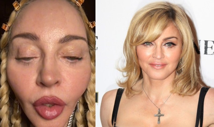Madonna cały czas dzieli się w mediach społecznościowych nowymi zdjęciami. Od miesięcy toczy się dyskusja na temat dynamicznie zmieniającej się twarzy gwiazdy. Tym razem pokazała się bez retuszu, a wygląd piosenkarki jest porażający!