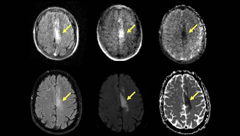 Aparatul RMN portabil va ajuta la detectarea accidentului vascular cerebral