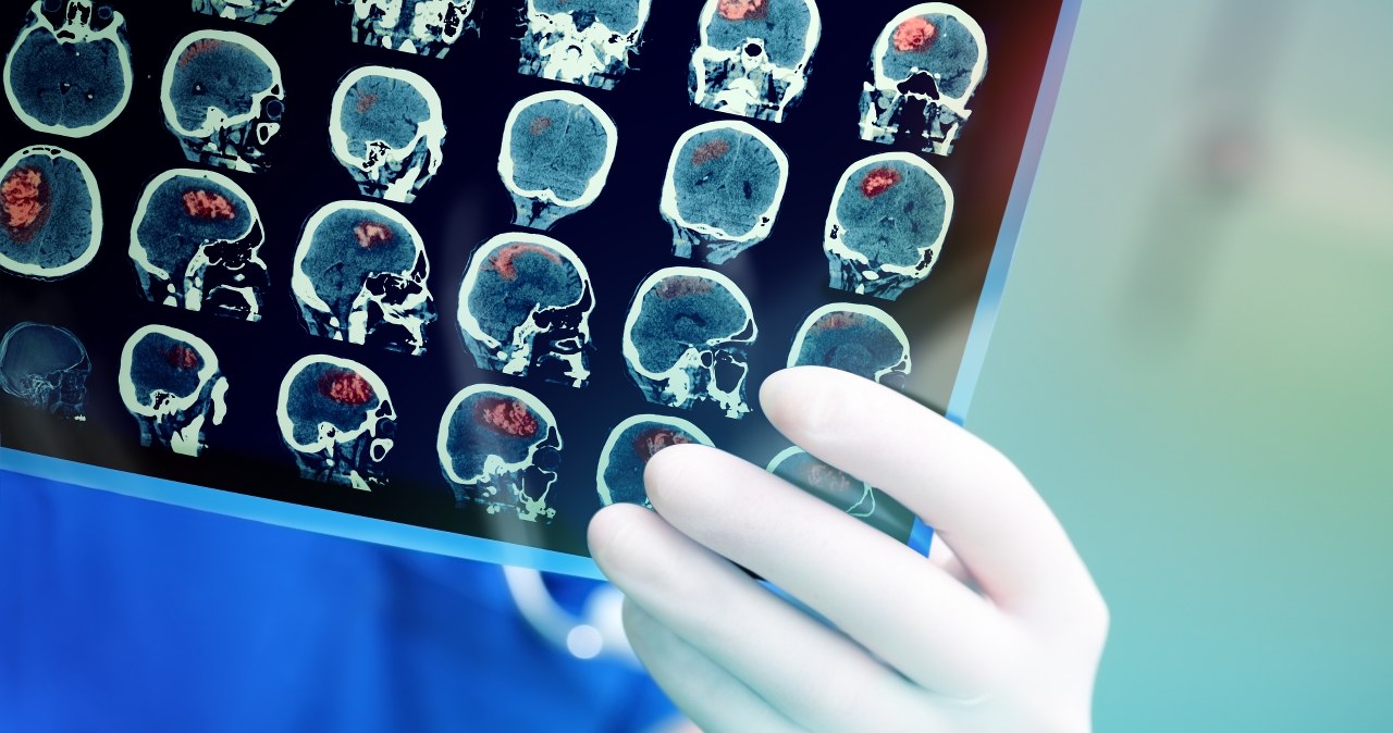 Nowy test DNA błyskawicznie diagnozuje guzy mózgu. Jeszcze podczas operacji