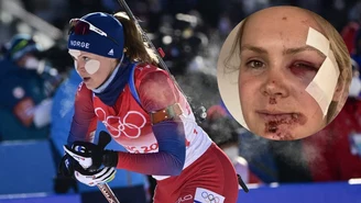 Straszny wypadek biathlonistki. Poturbowana twarz mówi wszystko