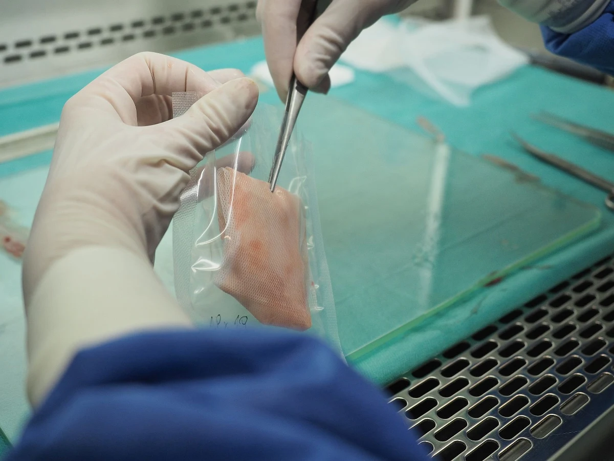 Zespół Szpitali Miejskich w Chorzowie to kolejna placówka medyczna, która będzie pozyskiwać owodnię dla Centrum Leczenia Oparzeń w Siemianowicach Śląskich. Owodnia jest wykorzystywana do terapii m.inn. oparzeń. Z takiego leczenia korzystają też górnicy ranni w wybuchu metanu w kopalni Pniówek. 