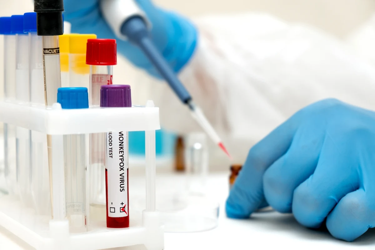 Szybkie testy w kierunku małpiej ospy rozpoczną się za tydzień w Wojewódzkim Szpitalu Zakaźnym w Warszawie. Do tej pory w Polsce potwierdzono jeden przypadek tej choroby. Siedem kolejnych osób przebywa w stołecznej placówce z podejrzeniem małpiej ospy.