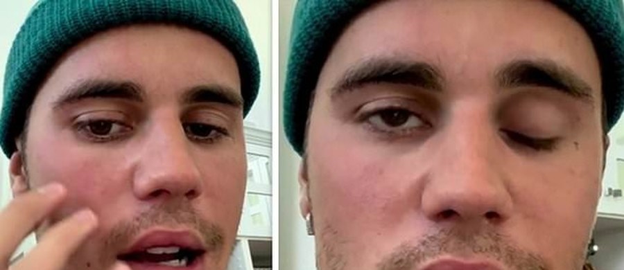Po tym, jak Justin Bieber ogłosił, że robi sobie przerwę w występach z powodu paraliżu jednej strony twarzy, wielu internautów poszukuje informacji o tej rzadkiej chorobie. Co ją wywołuje i jakie objawy powoduje?