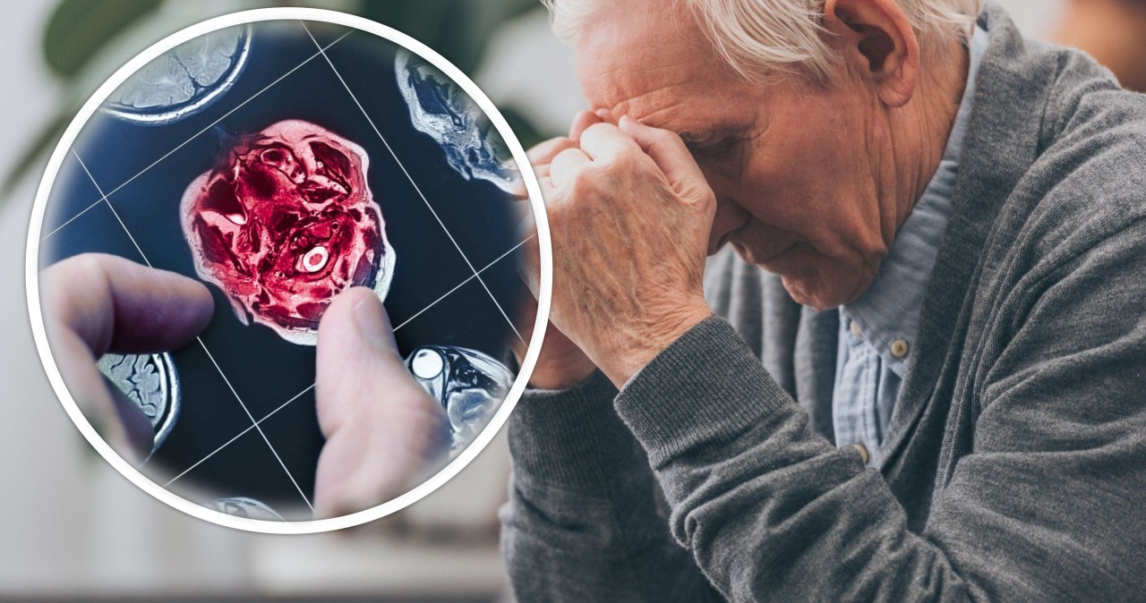 Przełom w leczeniu Alzheimera. Odkryli sposób na cofnięcie choroby