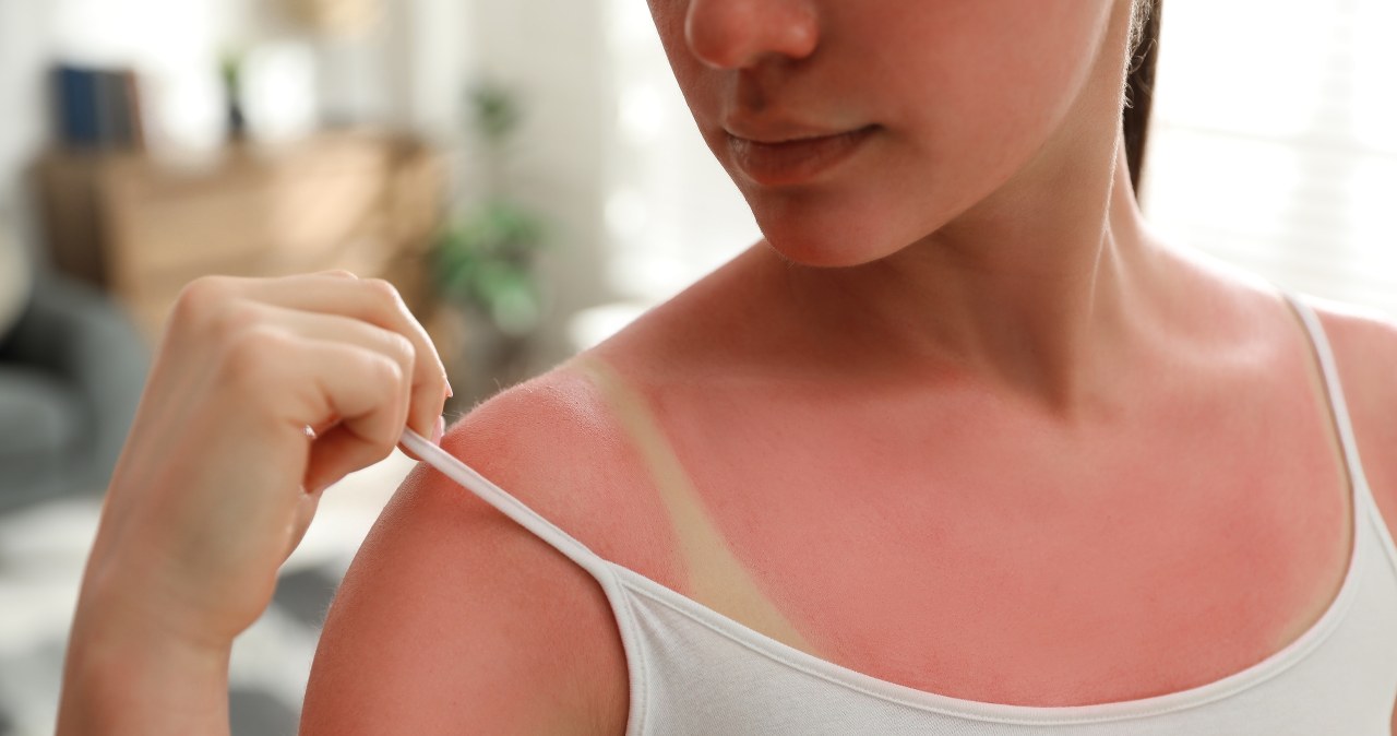 Czerwona i piekąca skóra po opalaniu? Weź to z kuchni i zapomnij o bólu