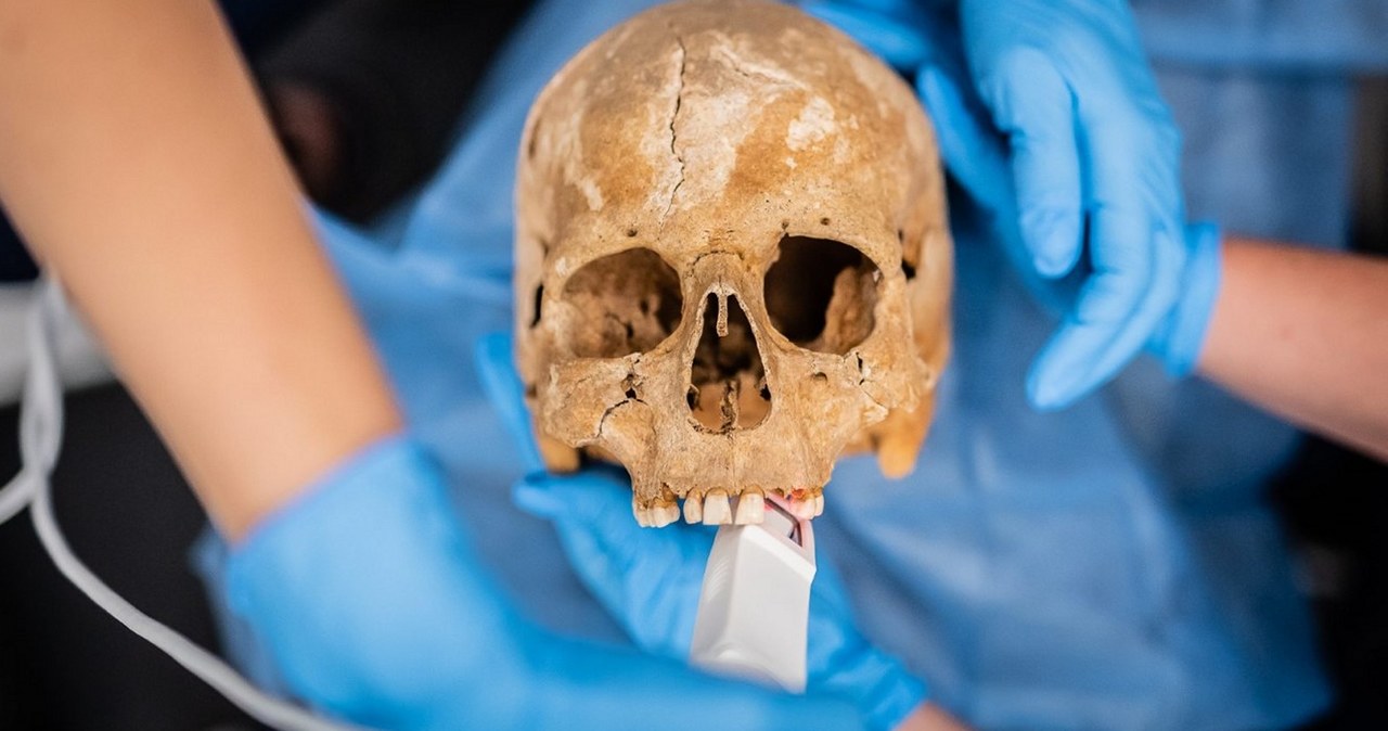 Badania zębów z czaszek pochodzących z późnośredniowiecznego cmentarza odkrytego w Gliwicach pokazały, że próchnica i jej powikłania nie dokuczały naszym przodkom w takiej skali, jak nam teraz.