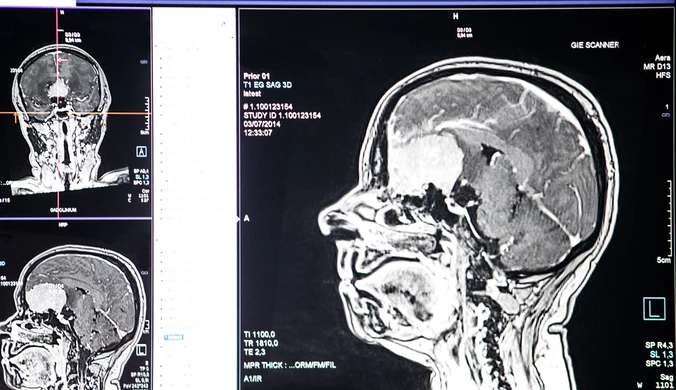 Prof. Gut: COVID-19 może spowodować zmniejszenie mózgu