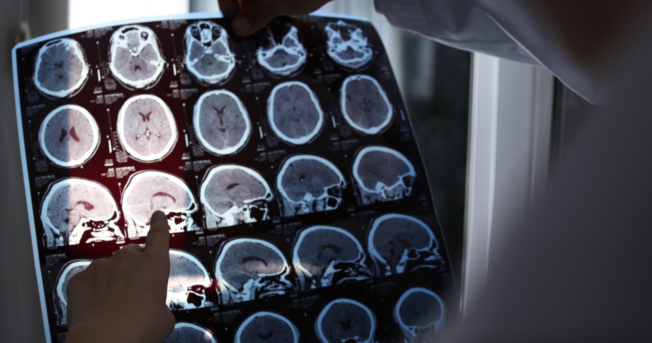 Rak może emitować sygnały chroniące mózg przed chorobą Alzheimera