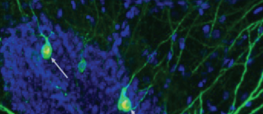 Przyspieszenie procesu powstawania nowych komórek nerwowych w mózgu myszy dotkniętych chorobą Alzheimera pomaga przywrócić im pamięć - informują na łamach czasopisma "Journal of Experimental Medicine" naukowcy z University of Illinois w Chicago. Wyniki ich badań wskazują na to, że nowe połączenia nerwowe mogą wbudowywać się w odpowiedzialne za zapamiętywanie struktury mózgu i mogą prowadzić do odblokowania wspomnień. To potencjalna szansa na nową metodę terapii, która mogłaby pomóc osobom dotkniętym towarzyszącą tej chorobie demencją. Taka terapia pozwoliłaby nie ograniczać się do hamowania postępów choroby Alzheimera, ale i odwracać jej skutki. 