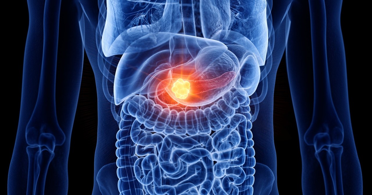 Naukowcy Duke University poinformowali, że opracowali nowatorski system dostarczania leków przeciwnowotworowych i zademonstrowali jego potencjał w walce z jedną najbardziej kłopotliwych postaci tej choroby, rakiem trzustki.