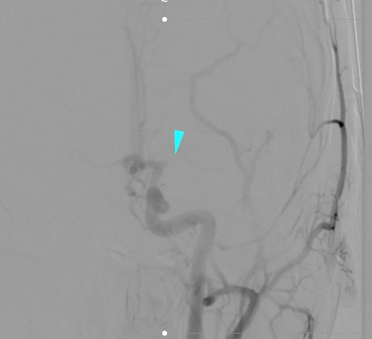 W Wojskowym Instytucie Medycznym w Warszawie, miał miejsce pierwszy przełomowy zabieg leczenia ostrego udaru mózgu u trzynastoletniego dziecka. Pacjent został przywieziony z Ciechanowa. Operacja odbyła się z wykorzystaniem trombektomii mechanicznej - najnowszej metody leczenia udaru niedokrwiennego mózgu, polegającej na instrumentalnym usunięciu skrzepliny z naczynia tętniczego mózgowia. 