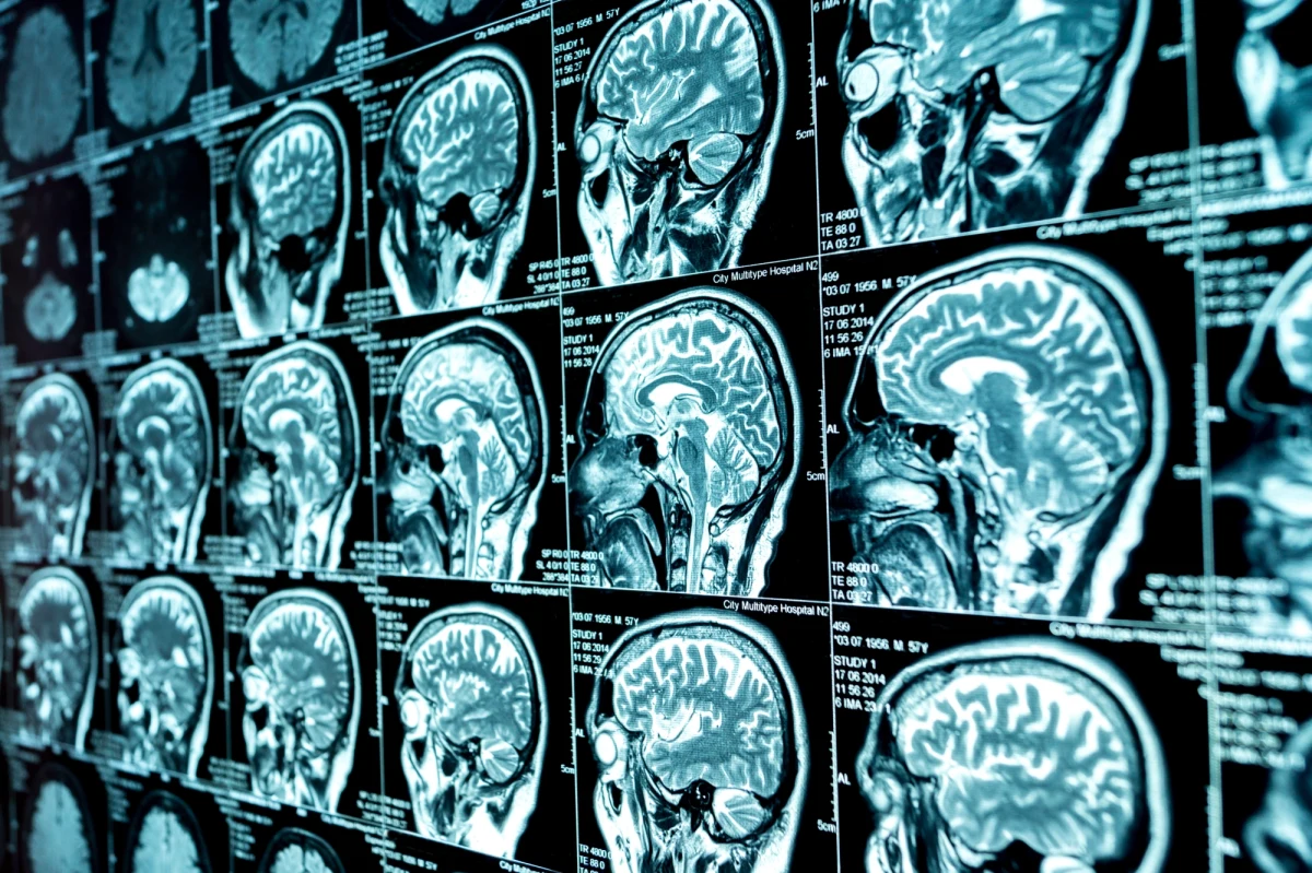 Pandemia i związany z nią stres spowodowały, że mózgi nastolatków zaczęły starzeć się wyjątkowo szybko. Następstwa tych zmian są podobne do zaobserwowanych wcześniej u ofiar przemocy, osób doświadczających zaniedbań czy żyjących w dysfunkcyjnych rodzinach.