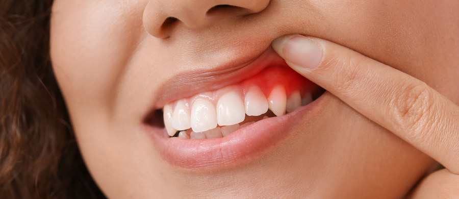 Jeśli uważasz, że czerwony ślad na szczoteczce po myciu zębów to nic groźnego, koniecznie zmień swoje nastawienie. Choroby dziąseł i przyzębia dotykają większości osób, a ich powody są często prozaiczne, jak na przykład niewystarczająca higiena. Jednak nie zawsze krwawienie dziąseł musi od razu oznaczać paradontozę. Co jeszcze?