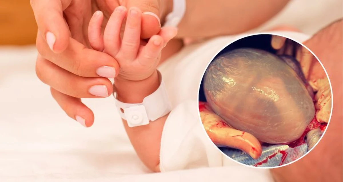 Położnicy z cudem narodzin mają do czynienia wiele razy dziennie. Jednak niektóre porody szczególnie zapadają w pamięci nawet im. Niezwykłe narodziny miały miejsce ostatnio w warszawskim Szpitalu Południowym, gdzie na świat przyszło dziecko w worku owodniowym. Mały pacjent przyszedł na świat za pomocą cesarskiego cięcia.